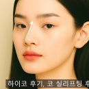 강남 코리프팅 잘하는 병원 하이코 시술 후기(실 2줄, 효과있을까?)