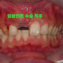 더바른치과기공소 | 달서구 임플란트 치과 , 오래된 브릿지 속 충치 치료 사례