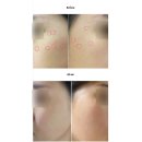 차한의원 | 강남역 한의원 편평사마귀제거 1주차 후기