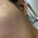 동그라미약국 | 청주 편평사마귀 레이저치료 제거후기2(사진혐/내돈내산)