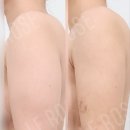 더마음의원 | [내돈내산] 청담 르로제의원 팔뚝 지방 흡입 2주 차 후기
