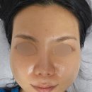 삼일사우나 | 온다리프팅 솔직 후기 및 통증 1주일 변화