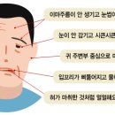 이런 증상 나타나면… 혹시 말초성 안면신경마비? 이미지