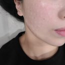 바노바기의원 | 서면 바노바기 의원 리쥬란힐러 일주일후기 + 엠보관리 꿀팁 공개