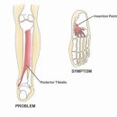 세븐일레븐(부전점) | [매화동 하움필라테스]발&amp;발목 운동전문가 후기 : 후경골근 기능부전 PTTD &amp; 평발의 대해서