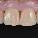 이사이치과의원 | 치과 공포 심한 분 이사이 벌어짐 + 앞니 충치 당일 치료 후기