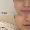 명륜한의원 | 동래 윤곽관리 잘하는 곳 보아르에스테틱 에서 리프팅 관리받고 온 후기