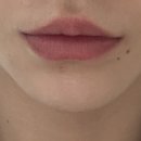 청담약국 | 청담피부과 압구정로데오역 입술필러 맛집 리얼후기