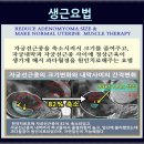 금정경희한의원 | 금정구 자궁근종 20년 전 처음 발견된 자궁선근종 현재 상태는?