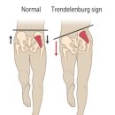 골반교정 필라테스 이미지