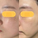 씨유 서영더엘점 | 검단 불로동 피부관리 한 번 만으로 주근깨 기미 큰 효과 본 비비드엘