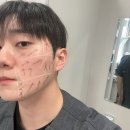 일산리프팅 고주파-초음파-실리프팅 분석해 보자 [리프팅 총정리]
