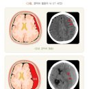 자발성 뇌출혈과 외상성 뇌출혈의 비교 이미지