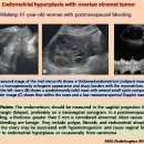 Endometrial hyperplasia with ovarian stromal tumor 이미지