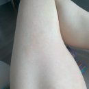 중기 임신 소양증 가려움 두드러기 5일 만에 없앤 치료방법(사용 제품 총정리)