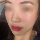 르노삼성자동차수성점 | 대구 수성구 비립종 제거 잘하는 프레야뷰티