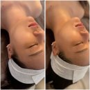 YP SKIN Therapy (YP 스킨 테라피) | 김해 장유 골드테라피 리프팅 온다+써마튠 후기｜팔자주름·이중턱·비대칭 광대 관리후기