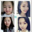 눈매교정후기 ※변화된모습