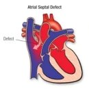 심방 중격 결손증[atrial septal defect, ASD] 이미지