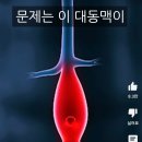 대동맥류 알아 보는법. feat.뇌피셜로 진단 이미지