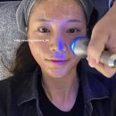 2주 만에 엑소좀 스킨부스터로 여드름 항균 효과 본 후기
