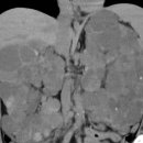 Autosomal Dominant Polycystic Kidney Disease- CT 이미지