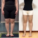 분당-3 | 분당 허벅지 지방추출주사 Q&amp;A 3개월 후기