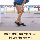 박영진의원 | 갑자기 퉁퉁 부은 다리, 다리 근육 파열 치료 후기