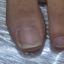 아산메디칼 | 아산 탕정 문제성 손 발 엔케어센터 내성발톱 후기