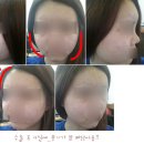 [브이성형외과] 대구 지방이식 잘하는곳 대구 지방이식 수술후기 (얼굴전체) 이미지