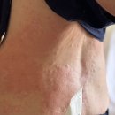 88종합의료기 | 발리여행 중 두드러기 증상 발리병원 간 후기 • 병원비 • AXA여행자보험 보상 하루만에 입금...