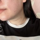 ‘모피우스후기‘ 모공흉터 때문에 선택한 시술 효과 통증 솔직정리 (비포애프터) 모피우스 1회차