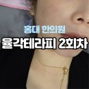 율각테라피 새살침 홍대 한의원 관리 솔직후기