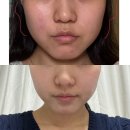 정평초등학교 | 경산웨딩관리 미레브 3회차 후기 제이유니에스테틱