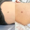 [대구/동구] 대구피부과 점잘빼는곳 몸 점제거 후기