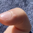 파티마피부과의원 | [춘천피부과] 파티마의원에서 사마귀 냉동치료