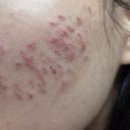 청산한의원 | 온바디 한의원 강남점, 패인 흉터 새살침/새싹침 후기(2회차) / 내돈내산/부작용