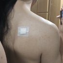 화산약국 | 내몸일기 피부낭종 제거 후기