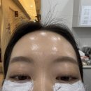 눈 밑 필러 후기 /눈 밑 꺼짐 다크서클
