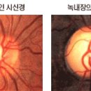 **녹내장 이미지