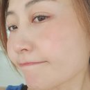 기미만세공원 | 일산피코토닝으로 기미 제거한 레이저토닝 후기