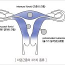 자궁근종과 치료 방제 이미지