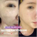 타토아의원 용인점 | 얼굴점빼기,잡티제거에 좋은 클라리티 3회차 찐후기
