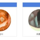 방사선 치료 후 성대 마비 및 성대 삽입술에 관하여 이미지