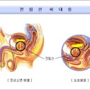 그놈 의 전립선 수술기(수컷 필독!.) 이미지