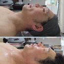 이투 | 남양주 다산동 채원뷰티 광대골절 수술 후 감각장애 얼굴비대칭으로 받아본 닥터이투 프로 체험 후기