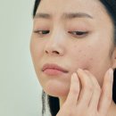 "약 없이 여드름 90% 없앴다?" '이 방법' 뭐길래? 이미지