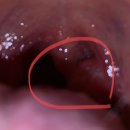 급성편도염 입원치료해야할까요ㅠ 이미지