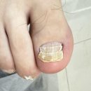 구로-구로-구로-1452 | [구로/신도림/영등포] 노랗고 바스러지고 변형이 있는 내 무좀발톱 왜 이럴까?