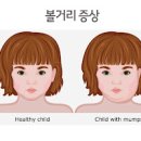 볼거리 유행성이하선염 증상 원인 전염 격리 이미지